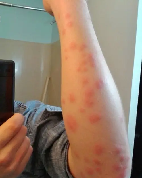 What Does a Potato Bug Bite Look Like