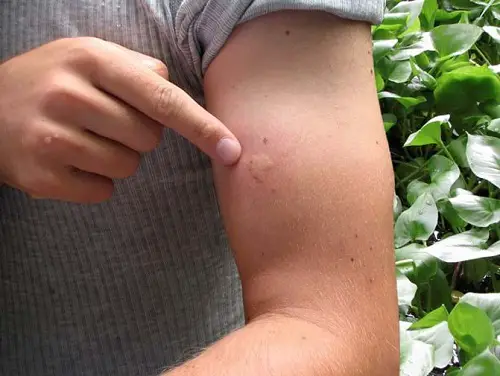 Symptoms of Carpenter Bee Sting