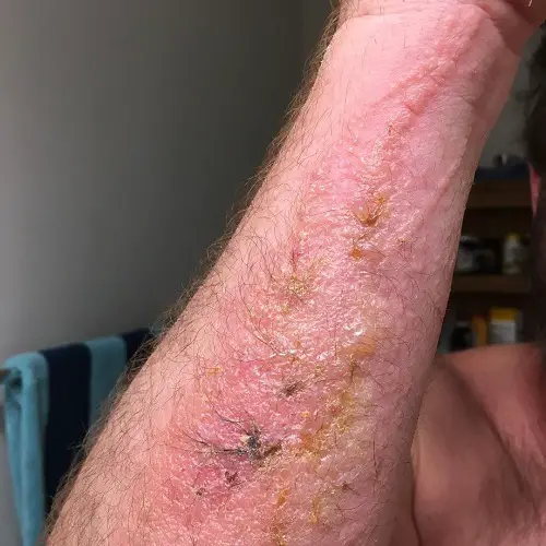 poison ivy reaction skin
