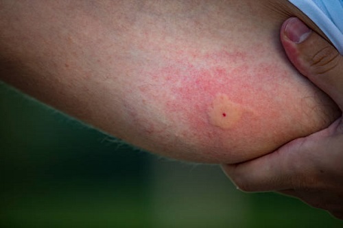 Symptoms of Bumble Bee Sting