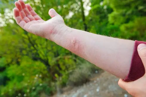 How Does Praying Mantis Bite Feel
