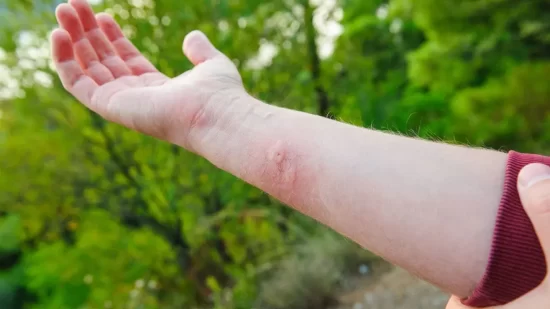 What to Do if a Praying Mantis Bites You